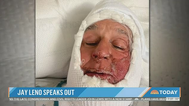 A doctor performed skin grafts on the star, removing his burnt skin and replacing it with skin from a skin bank