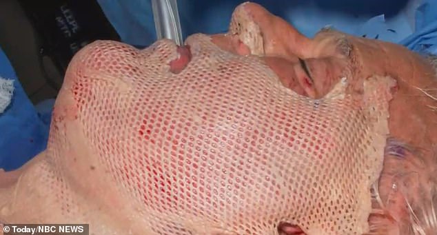 Temporary skin grafts from 'human cadaver skin' were added to the comedian's body after he suffered horrific burns when an engine exploded in his face on November 12